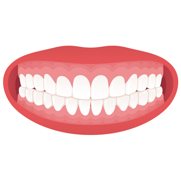 overbite